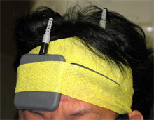 ТЕС транскраниална стимулация с прав ток tDCS